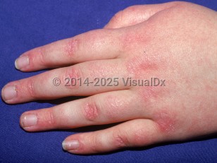 Juvenile dermatomyositis