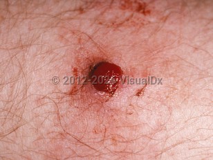 Lobular capillary hemangioma
