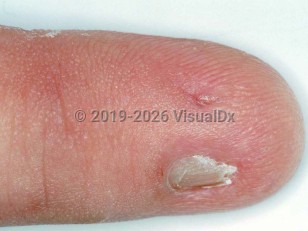 Congenital onychodysplasia