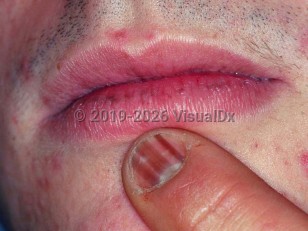 Laugier-Hunziker syndrome