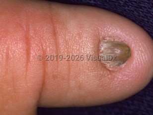 Congenital micronychia