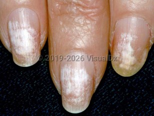 Nail polish damage