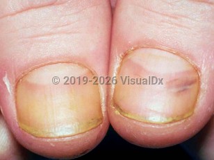 Pesticide-induced nail changes