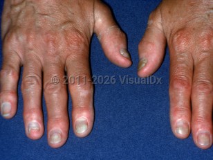 Clinical image of Thyroid acropachy - imageId=1665530. Click to open in gallery.  caption: 'Onycholysis in hyperthyroidism.'