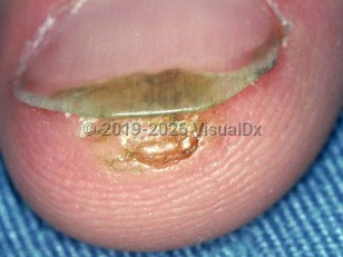 Subungual wart
