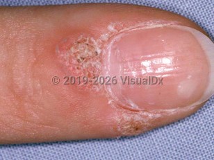 Periungual wart