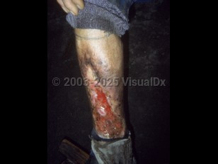 Clinical image of Glanders - imageId=1667527. Click to open in gallery.  caption: 'A deep ulcer with surrounding hyperpigmentation and scarring on the leg.'