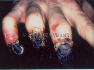 Septicemic plague
