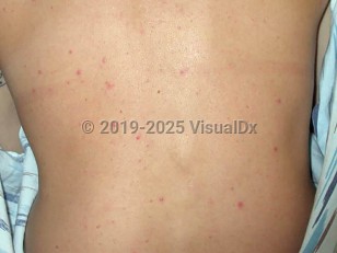 Clinical image of Vaccinia-Induced folliculitis - imageId=1673059. Click to open in gallery.  caption: 'Scattered pink follicular papules on the back.'