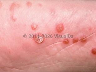 Clinical image of Reactive arthritis - imageId=167480. Click to open in gallery.  caption: 'A close-up of brown, incipient crusts, some with overlying scale, on the sole.'