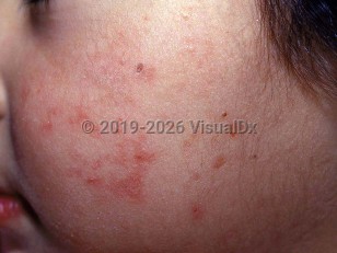 Congenital erythropoietic porphyria
