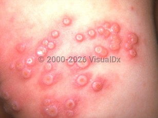 Clinical image of Eczema vaccinatum vaccinia - imageId=169206. Click to open in gallery.  caption: 'A close-up of a cluster of umbilicated and crusted pustules, each with an erythematous halo.'