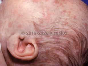 Acute myelomonocytic leukemia