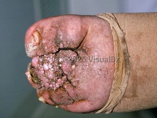 Elephantiasis nostras verrucosa