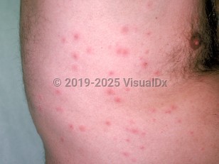 Pseudomonas folliculitis
