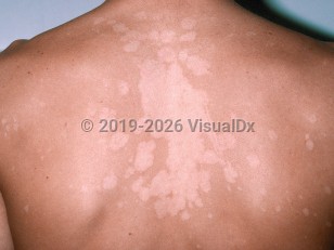 Clinical image of Tinea versicolor - imageId=177139. Click to open in gallery.  caption: 'Flat, scaly hypopigmented papules and plaques on the back.'