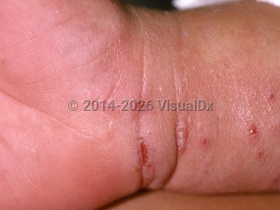 Clinical image of Scabies - imageId=177763. Click to open in gallery.  caption: 'Excoriations and a burrow at the wrist.'