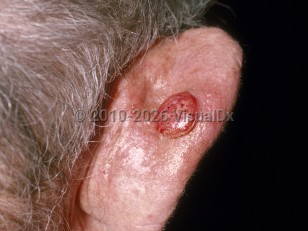 Cutaneous squamous cell carcinoma