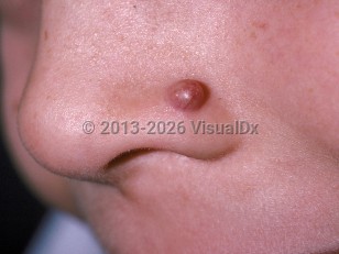 Pilomatricoma