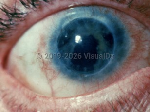 Clinical image of Ocular syphilis - imageId=1805002. Click to open in gallery.  caption: 'Interstitial keratitis.&nbsp;'