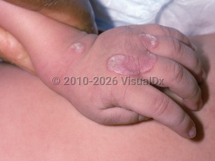 Vitamin A deficiency