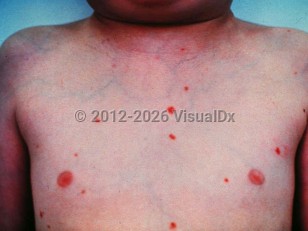 Sinus histiocytosis with massive lymphadenopathy