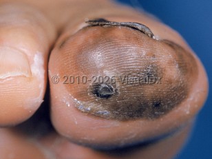 Acral lentiginous melanoma