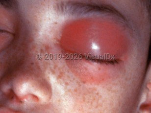 Clinical image of Cavernous sinus thrombosis - imageId=1850125. Click to open in gallery.  caption: 'Marked edema and erythema of the upper eyelid and less marked similar features of the lower eyelid.'