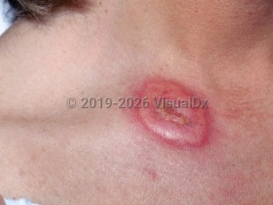 Clinical image of Acute febrile neutrophilic dermatosis - imageId=1858339. Click to open in gallery.  caption: 'A well-demarcated, deep pink, pseudovesicular plaque over the medial clavicle.'
