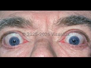 Clinical image of Graves ophthalmopathy - imageId=1858880. Click to open in gallery.  caption: 'Proptosis secondary to Graves disease.'
