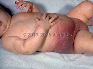 Clinical image of Kasabach-Merritt phenomenon - imageId=1859794. Click to open in gallery.  caption: 'A giant indurated and edematous, erythematous and violaceous mass involving the right flank and abdomen and the suprapubic area.'
