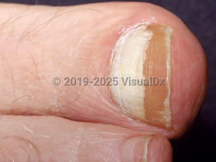 Clinical image of Proximal subungual onychomycosis - imageId=1862878. Click to open in gallery.  caption: 'Diffuse white discoloration of the proximal great toenail.'