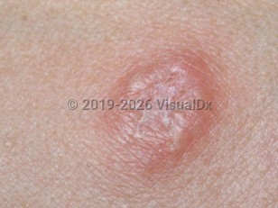 Clinical image of Brucellosis - imageId=1874956. Click to open in gallery.  caption: 'A close-up of an edematous papule with overlying scale and a central dell.'