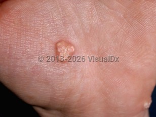 Calcinosis cutis