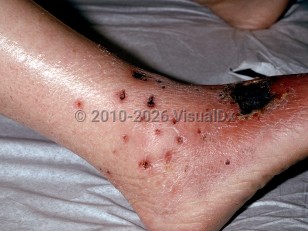 Clinical image of Eosinophilic granulomatosis with polyangiitis - imageId=187886. Click to open in gallery.  caption: 'Several tiny, punched-out, crusted ulcers around the ankle and some larger ulcers with overlying eschars and surrounding erythema on the dorsal foot and lower shin.'