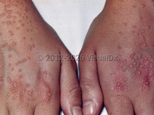 Flat wart