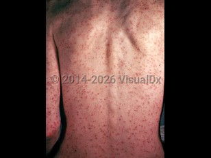 Colorado tick fever