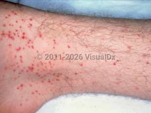 Clinical image of Atypical measles syndrome - imageId=1897265. Click to open in gallery.  caption: 'Numerous purpuric macules and papules on the leg.'