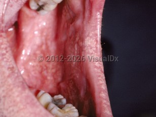 Fordyce spots