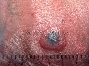 Milker's nodules