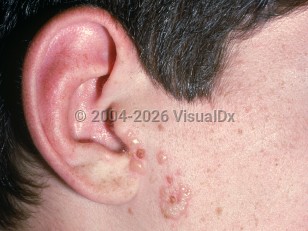 Gladiatorum herpes simplex virus