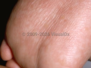 Clinical image of Naegeli syndrome - imageId=192511. Click to open in gallery.  caption: 'Punctate hyperkeratotic papules and effacement of dermatoglyphics on the sole.'