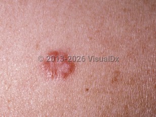 Sarcoidosis