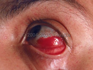 Subconjunctival hemorrhage