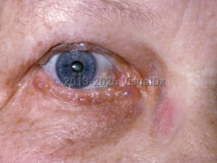 Apocrine hidrocystoma