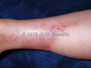 Panniculitis