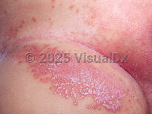 Clinical image of Diaper dermatitis candidiasis - imageId=2026908. Click to open in gallery.  caption: 'An erythematous plaque studded with pustules on the upper thigh, pink plaques in the inguinal fold and on the vulva, and erythematous papules on the lower abdomen.'