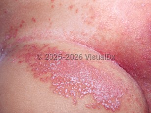 Diaper dermatitis candidiasis