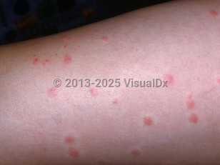 Clinical image of Cercarial dermatitis - imageId=2032752. Click to open in gallery.  caption: 'Erythematous and edematous papules, many with a blanched halo, and some tiny crusts on the leg.'