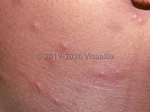 Flea bite